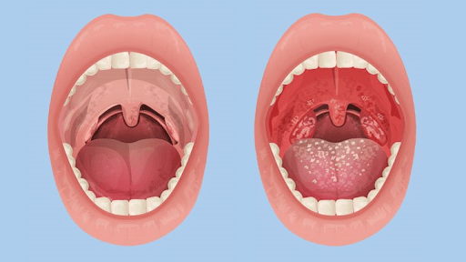 Đau nhức ở cổ họng là bệnh gì?
