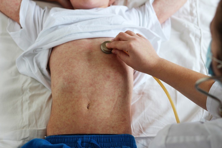 Bệnh sởi bệnh truyền nhiễm gây ra bởi virus Paramyxovirus