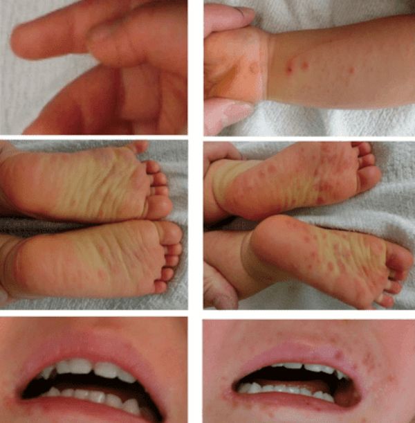 Khi bé bị tay chân miệng, các vết ban sẽ xuất hiện ngày càng nhiều sau thời gian ủ bệnh.