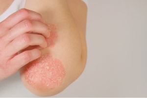viêm khớp vảy nến