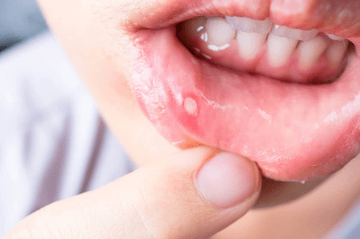 loét miệng là một trong các dấu hiệu trẻ mắc tay chân miệng