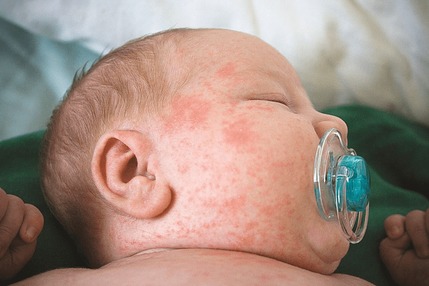  Bệnh sởi thường xảy ra ở những bé có hệ miễn dịch kém