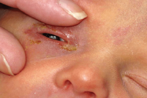 Cảm lạnh - một trong những nguyên nhân chính gây bệnh sốt mắt đổ ghèn ở trẻ