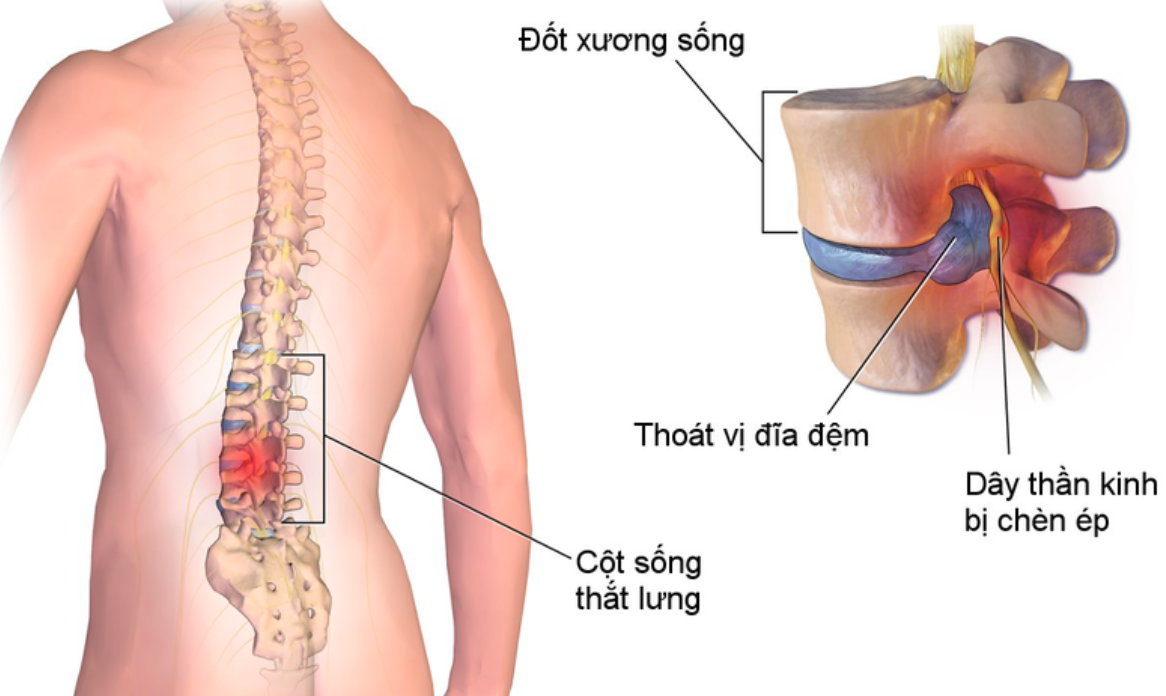 đau vùng mông gần xương cụt