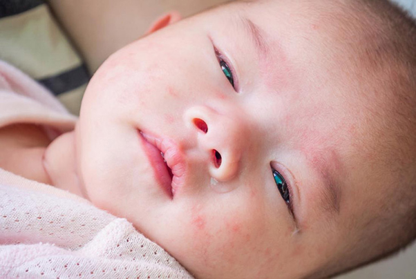 Những dấu hiệu bé bị sốt phát ban cha mẹ cần đặc biệt chú ý