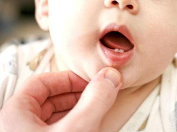 Bé mọc răng sớm có thể do di truyền hoặc lượng dinh dưỡng được cung cấp 