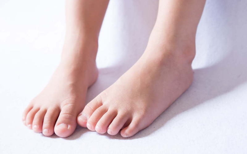Hội chứng bàn chân bẹt ngày càng phổ biến ở trẻ em