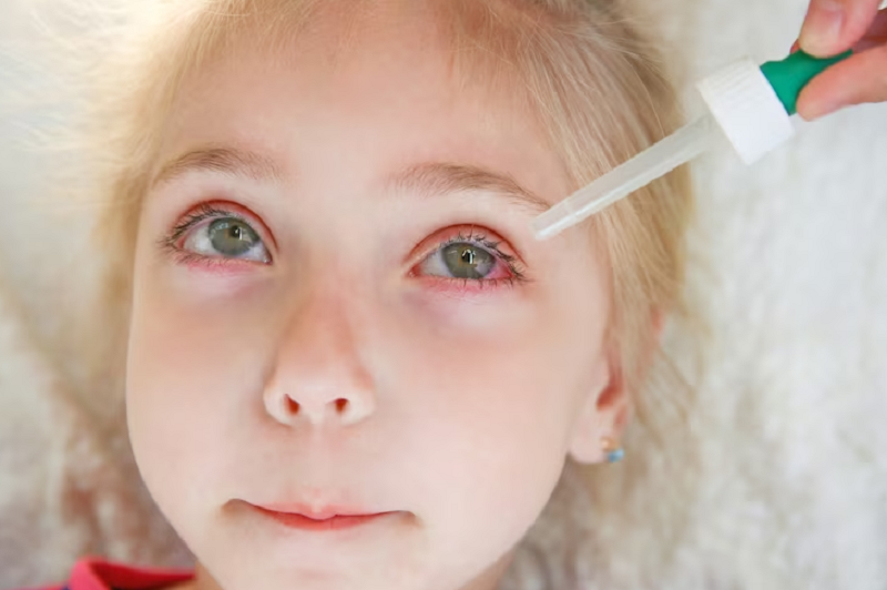 Những lưu ý khi điều trị trẻ sốt cao mắt đỏ